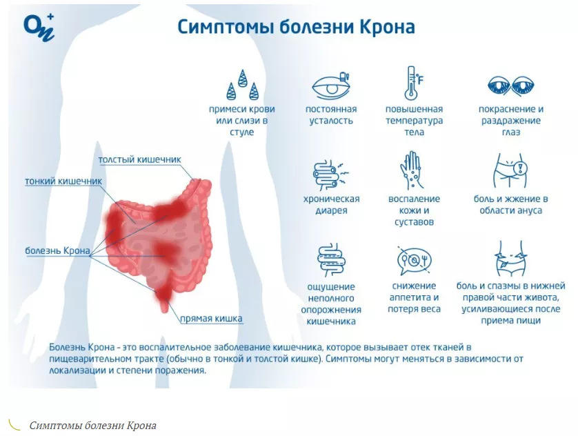 Пример изображения для страницы услуги «Лечение болезни Крона»